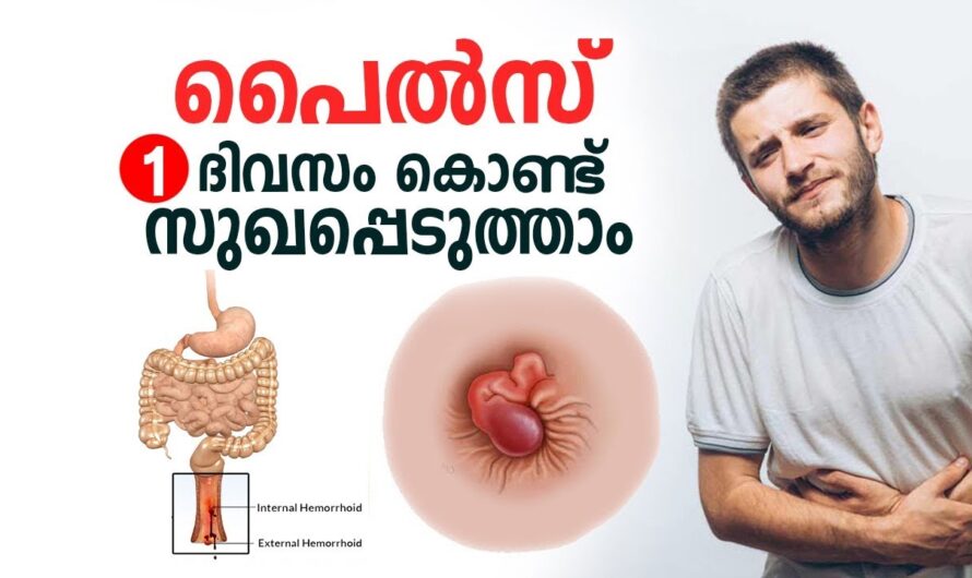 Why do piles occur? 6 reasons you should know!