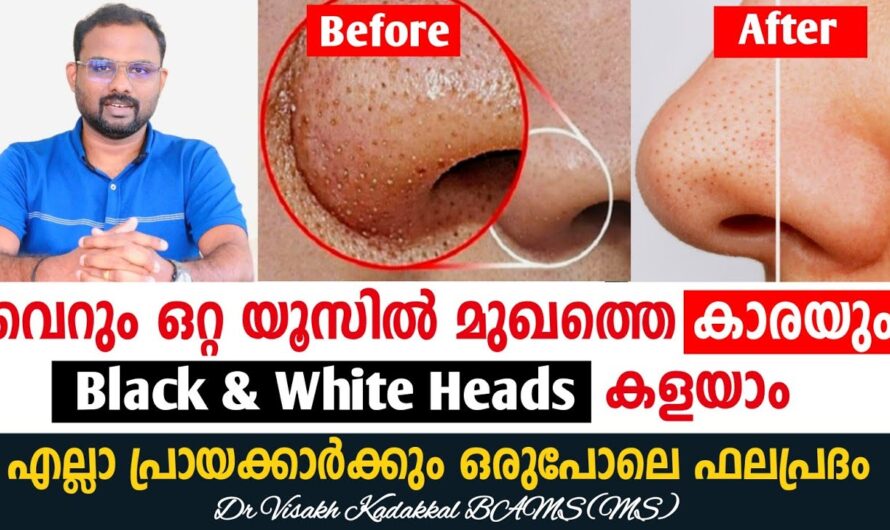 Blackheads and whiteheads on the face; Let’s identify the causes!