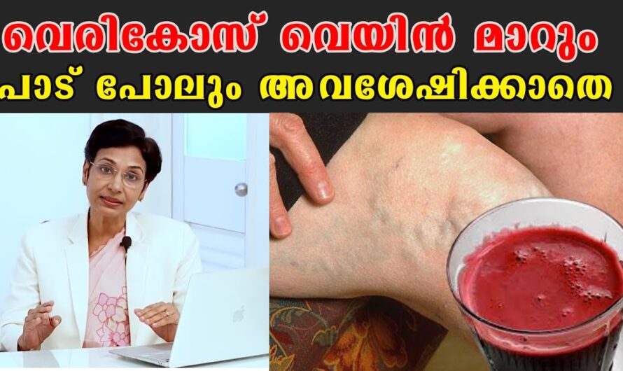 Are the veins in your legs swollen and swollen? 6 main causes of varicose veins!