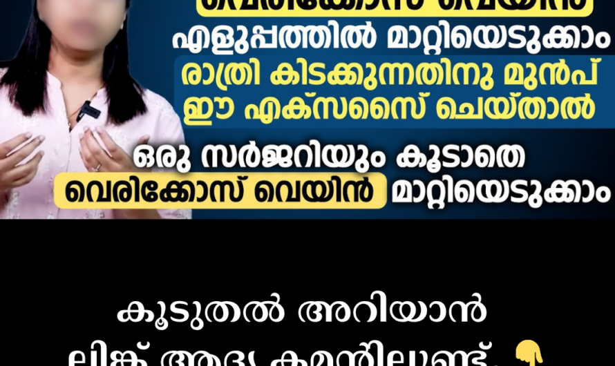 Are the veins in your legs swollen? 5 things that cause varicose veins