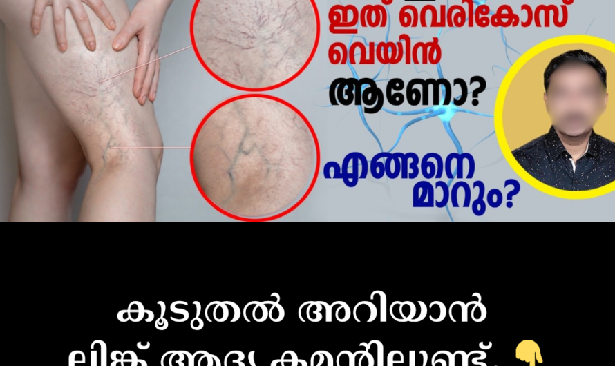 Are the veins in your legs swollen and turning blue? 5 things that cause varicose veins