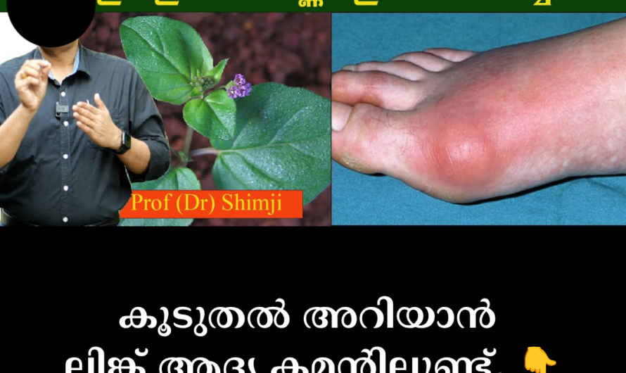 Severe needle-like pain in the joints? 5 main scientific reasons behind the increase in uric acid in the body