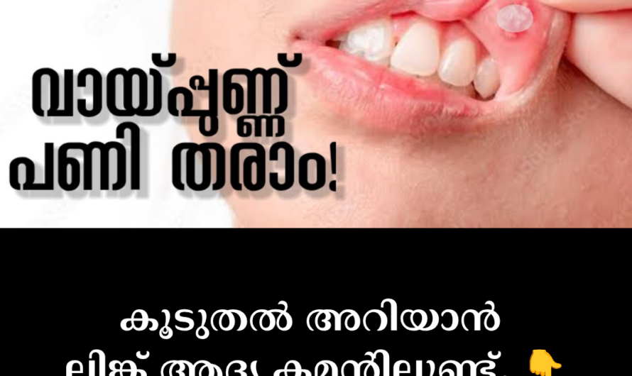Although mouth ulcers are very common, there are many reasons why they occur. Mouth ulcers are small sores that appear on the inside of the mouth, under the tongue, on the inside of the lips, or on the gums.