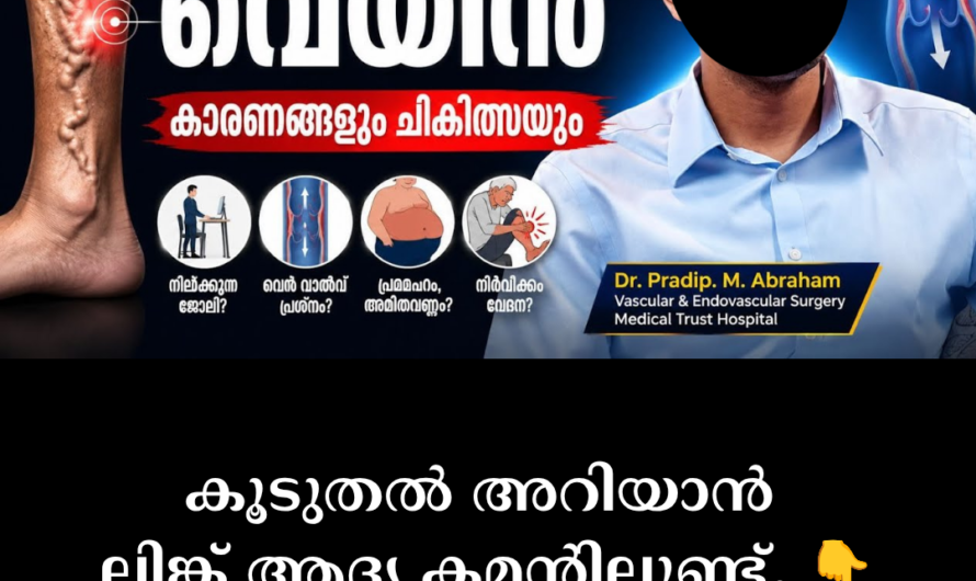 Main causes of varicose veins