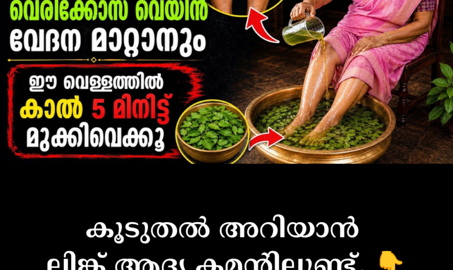 Main causes of varicose veins
